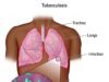 Public health group advocates renewed commitment, sustained investment against Tuberculosis scourge