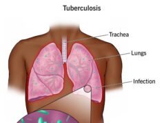 Public health group advocates renewed commitment, sustained investment against Tuberculosis scourge