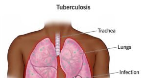 Public health group advocates renewed commitment, sustained investment against Tuberculosis scourge