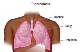 Public health group advocates renewed commitment, sustained investment against Tuberculosis scourge