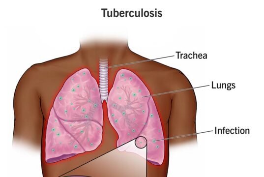 Public health group advocates renewed commitment, sustained investment against Tuberculosis scourge